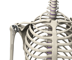 Outpatient Shoulder Replacement - Educational Picture