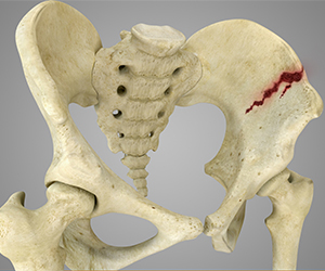 Pelvic Fractures - Educational Picture