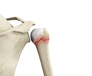 Proximal Humerus Fractures - Educational Picture