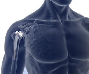 Reverse Shoulder Replacement - Educational Picture