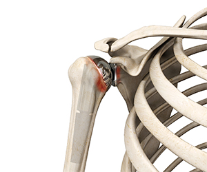 Revision Shoulder Replacement - Educational Picture