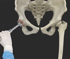 Robotic Assisted Total Hip Replacement - Educational Picture