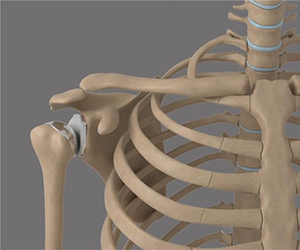 Robotic Assisted Shoulder Replacement - Educational Picture