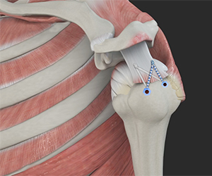 Rotator Cuff Repair - Educational Picture