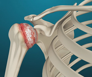 Arthritis of the Shoulder - Educational Picture