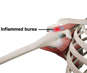 Shoulder Bursitis - Educational Picture
