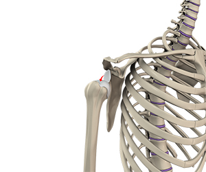 Shoulder Dislocation - Educational Picture