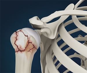 Shoulder Fracture - Educational Picture