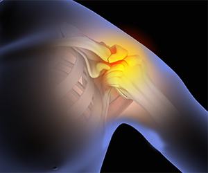 Shoulder Impingement - Educational Picture