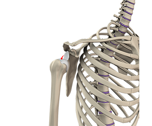 Shoulder Instability - Educational Picture