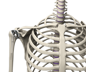 Shoulder Joint Replacement - Educational Picture