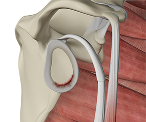 Shoulder Labral Tear - Educational Picture