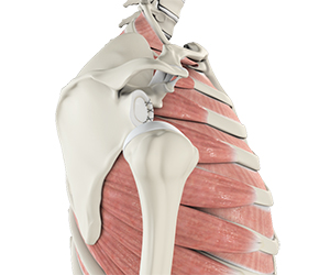 Shoulder Labrum Reconstruction - Educational Picture