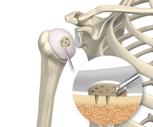 Shoulder Preservation Surgery - Educational Picture