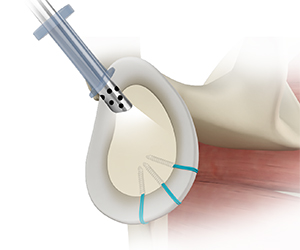Shoulder Reconstruction Surgery - Educational Picture