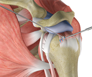 Shoulder Stabilization - Educational Picture