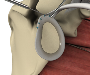 SLAP Repair - Educational Picture