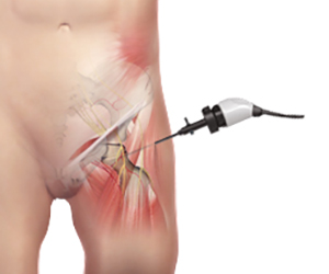 Snapping Hip Syndrome - Educational Picture