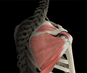 Shoulder Tendon Transfer - Educational Picture