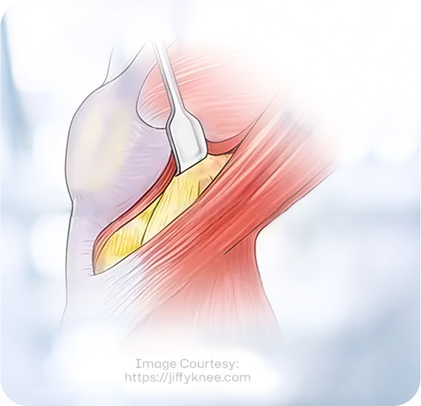 Joint Replacement img