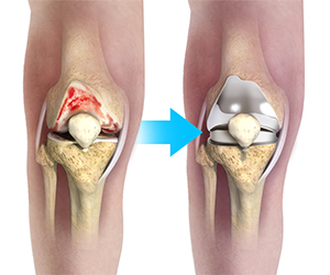 Complex Total Knee Replacement - Knee
