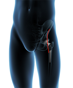Direct Anterior Hip Replacement - Hip