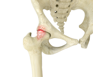 Femoroacetabular Impingement - Hip