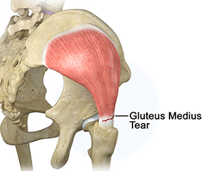 Gluteus Medius Tear - Hip