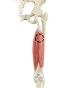 Hamstring Injuries - Hip