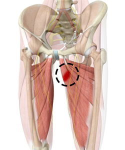 Hip Adductor Injuries - Hip