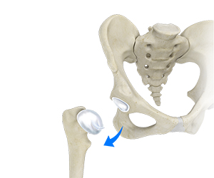Hip Dislocation - Hip