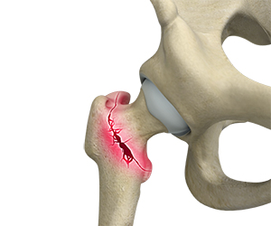 Hip Fracture - Hip