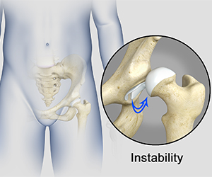 Hip Instability - Hip