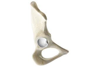 Hip Labral Tear - Hip