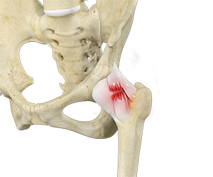 Hip Ligament Injuries - Hip