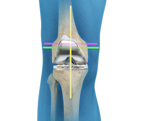 Kinematic Alignment (TKA) - Knee