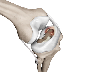 Meniscal Injuries - Knee