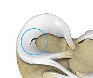 Meniscal Tears - Knee