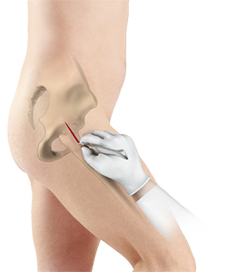 Minimally Invasive Total Hip Replacement - Hip