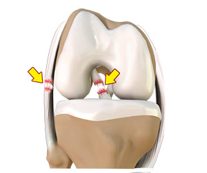Multiligament Instability - Knee