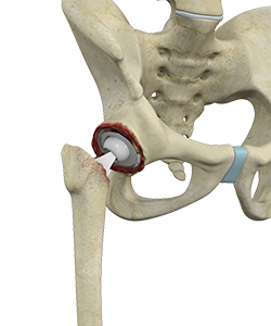 Revision Hip Replacement - Hip