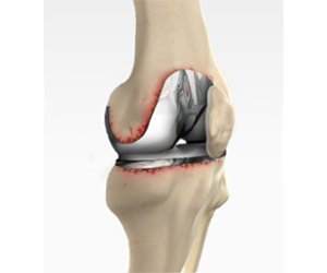 Revision Knee Replacement - Knee