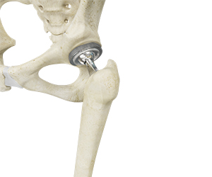 Total Hip Replacement - Hip