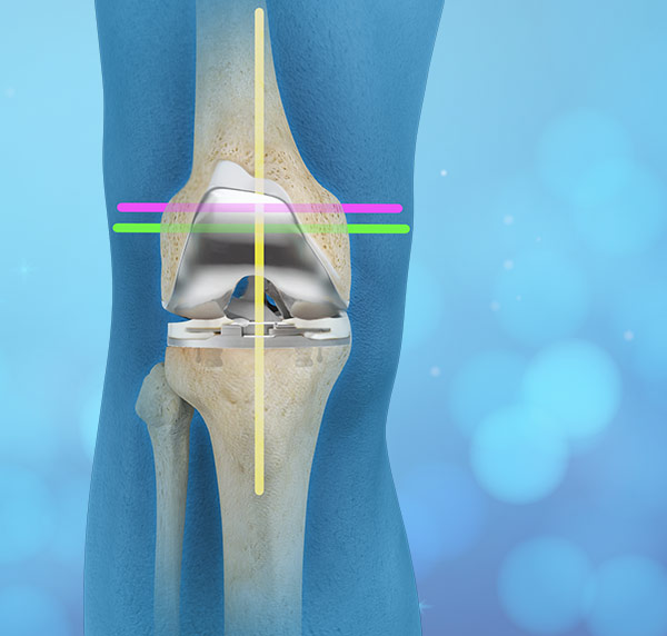 Kinematic Knee Replacement