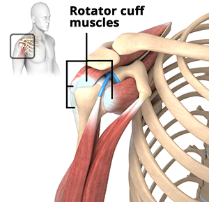 Rotator Cuff Sparing Shoulder Replacement