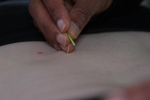 Acupuncture Img