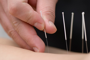 Acupuncture Img