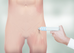 Extracorporeal Shockwave Therapy (ESWT) Img