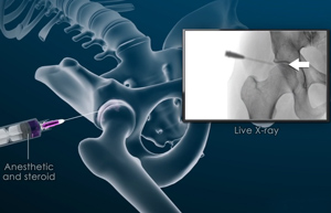 Hip Injections Img