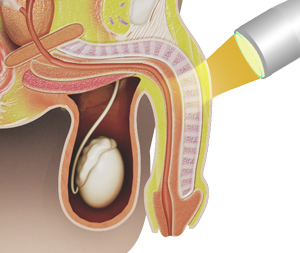 Shockwave Therapy for Erectile Dysfunction Img